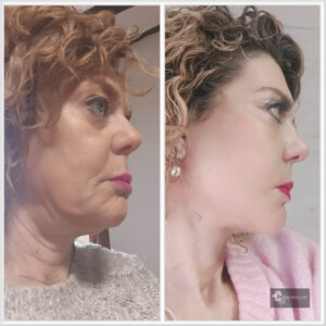 Deep Plane Facelift Turkey – Natural Face and Neck Rejuvenation Results